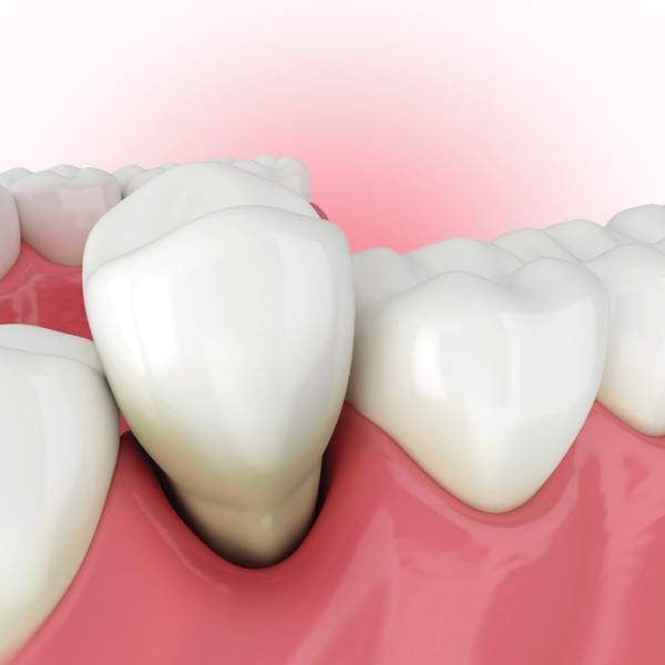 Single Tooth Extractions Shawnee KS | Tooth Removal Lenexa