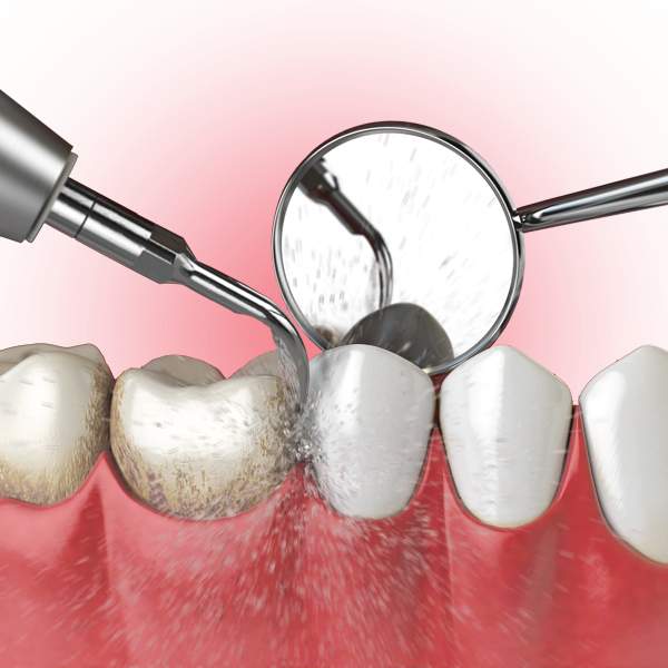 Regular Dental Cleaning vs Deep Cleaning: What is the Difference?